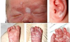 Bác sĩ chỉ cách phát hiện sớm và điều trị giang mai bẩm sinh