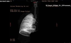 Gắp mảnh nhựa sắc nhọn, cứu bé 7 tuổi xẹp hoàn toàn phổi trái