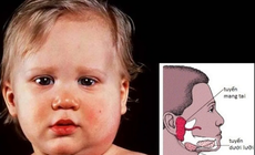 Bệnh quai bị bao lâu thì khỏi?