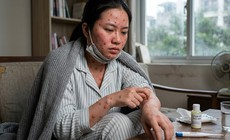 Cách điều trị bệnh thủy đậu tại nhà, ngăn ngừa sẹo