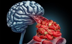 Dị dạng mạch máu: Dấu hiệu nhận biết và mức độ nguy hiểm không thể chủ quan