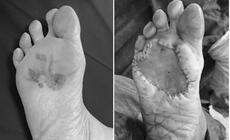 Vết đen ở bàn chân suốt 15 năm mới phát hiện ung thư