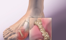 Người bệnh gout khổ sở với tiệc tùng cuối năm