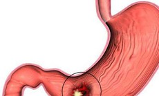 Viêm loét dạ dày dễ tái phát vào dịp cuối năm
