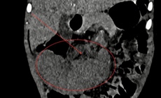 Phẫu thuật nội soi xử lý ca lách xoắn hiếm gặp ở trẻ 40 tháng tuổi