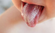 Nấm miệng có lây không?