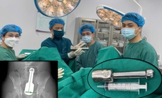 Thiếu niên 15 tuổi cấp cứu vì chiếc chày 18cm mắc kẹt hậu môn