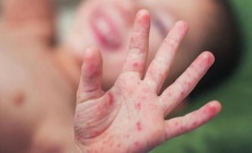 Lâm Đồng giám sát người tiếp xúc gần sau ca bệnh viêm màng não mô cầu