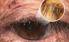 Phát hiện ổ rận mu bám dày trên mí mắt người phụ nữ