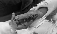 Tai nạn trong tích tắc vì pháo nổ, nam thanh niên suýt mất chức năng bàn tay