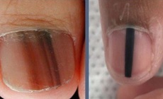 Sọc sẫm màu trên móng tay, móng chân là biểu hiện của bệnh gì?