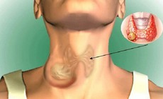 Nam giới mắc u tuyến giáp có nguy hiểm không?
