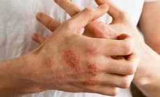 Ảnh hưởng lên da của bệnh đái tháo đường, dấu hiệu không nên bỏ qua