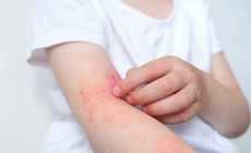 Cách chọn kem dưỡng ẩm trong liệu trình điều trị viêm da dị ứng tốt nhất