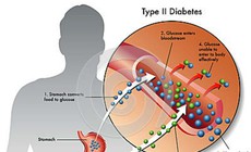 Loại thuốc trị đái tháo đường mới vừa kiểm soát đường huyết, vừa hỗ trợ giảm cân