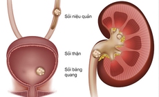 5 nguyên nhân làm tăng nguy cơ sỏi niệu quản và cách phòng ngừa hiệu quả