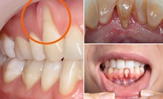 Tụt lợi có thực sự nguy hiểm?