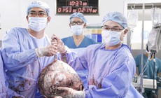 Bụng to bất thường, cô gái 25 tuổi phát hiện u xơ tử cung gần 12kg