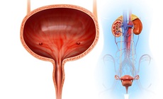 Thói quen xấu gây sỏi bàng quang