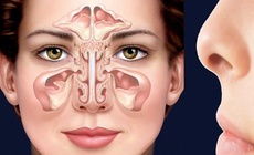 Đau hốc mắt kéo dài, coi chừng viêm xoang trán