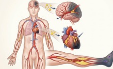 Những biến chứng nguy hiểm khi không kiểm soát mỡ máu