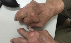 Gout mạn tính gây biến dạng khớp tay, chân xử trí ra sao?