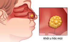 Nghẹt mũi kéo dài cảnh giác với ung thư hốc mũi