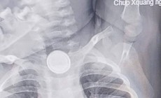 Nuốt pin cúc áo, bé 2 tuổi bỏng nặng thực quản