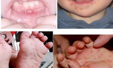 Số ca mắc tay chân miệng tăng cao, Lâm Đồng siết chặt phòng chống dịch