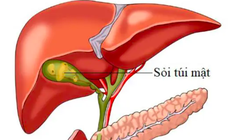 Dấu hiệu cảnh báo sỏi túi mật, nhận biết sớm để tránh biến chứng nguy hiểm