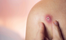 Thực phẩm giúp cải thiện tình trạng mụn nhọt trên da