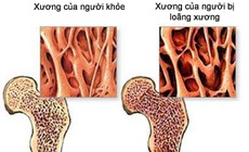 5 cách phòng loãng xương không dùng thuốc trước tuổi 40