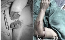 Hồi sinh cánh tay đứt lìa dập nát trong 'giờ vàng'