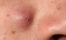 Mụn bọc trên mặt dễ biến chứng nếu tự ý nặn mụn