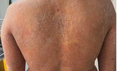 Dùng sai thuốc, nấm da lan toàn thân, ngứa dữ dội