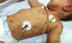 Bé gái 11 tuổi tử vong do viêm não mô cầu: Dấu hiệu nhận biết và cách phòng căn bệnh có nguy cơ tử vong trong 24 giờ