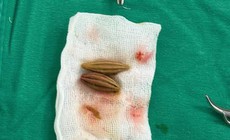 Cụ bà cao tuổi thủng trực tràng vì nuốt hạt nhót