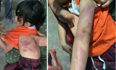 Bé gái lớp 2 bị bạn đánh bầm tím người