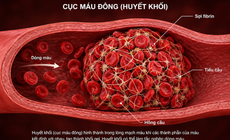 2 cách đơn giản ngăn ngừa cục máu đông