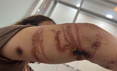 Cách xử trí đúng ban đầu bị sứa đốt khi đi du lịch biển