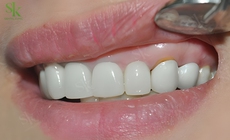 Vì sao bọc răng sứ hay bị viêm nướu?