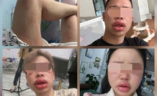 Sưng mắt, môi sau khi ăn bánh trứng kiến: Đặc sản hay 'thủ phạm'?