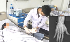 Vi phẫu cứu ngón tay đứt lìa cho nữ công nhân phụ hồ bị máy trộn bê tông cuốn nát bàn tay