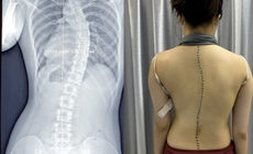 Vẹo cột sống ở trẻ gây hệ lụy gì?