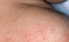 Mùa hè nhiều rôm sảy cần xử trí ra sao?