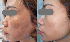 Bác sĩ chỉ rõ lý do nhiều người trị nám tốn kém nhưng vẫn tái phát