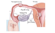 Hiếm gặp: Vừa có thai trong tử cung vừa có thai ngoài tử cung