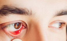 Nguyên nhân gây cộm mắt và cách khắc phục