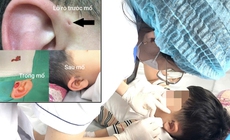 Hi hữu ca rò luân nhĩ di truyền qua 3 thế hệ