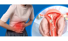 7 dấu hiệu thường gặp của lạc nội mạc tử cung chị em nên chú ý
